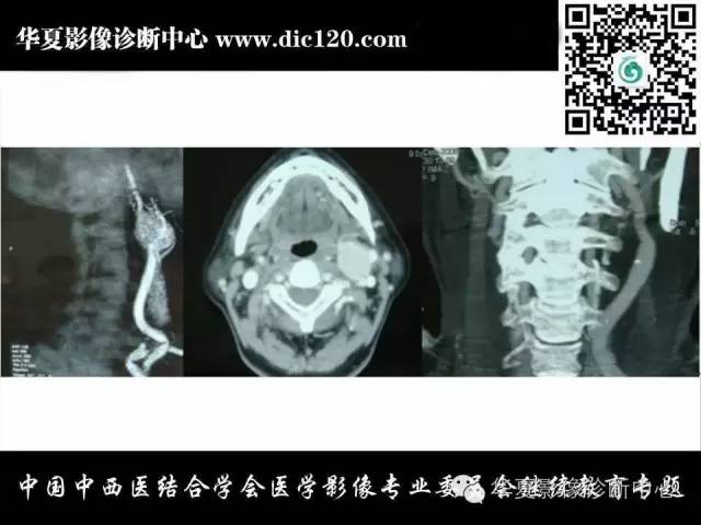 【PPT】颈部常见病变影像诊断