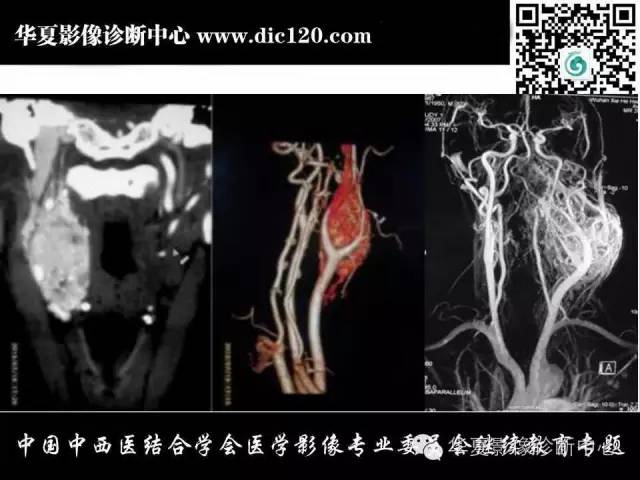 【PPT】颈部常见病变影像诊断