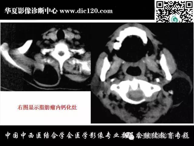 【PPT】颈部常见病变影像诊断