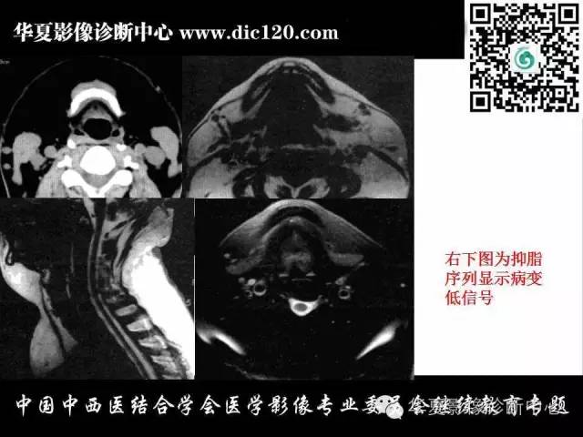 【PPT】颈部常见病变影像诊断