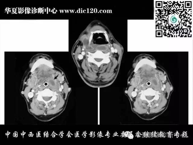 【PPT】颈部常见病变影像诊断
