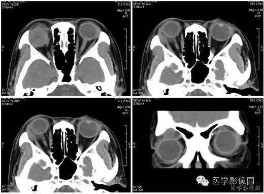 【病例】泪腺混合瘤1例CT影像表现 【病例】泪腺混合瘤1例CT影像表现