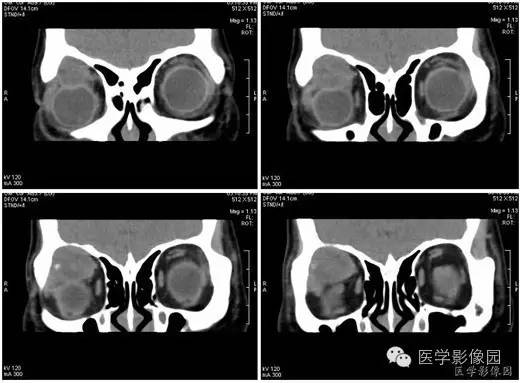 【病例】泪腺混合瘤1例CT影像表现 【病例】泪腺混合瘤1例CT影像表现