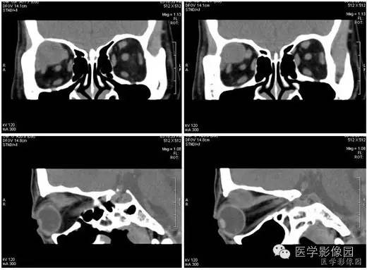 【病例】泪腺混合瘤1例CT影像表现 【病例】泪腺混合瘤1例CT影像表现