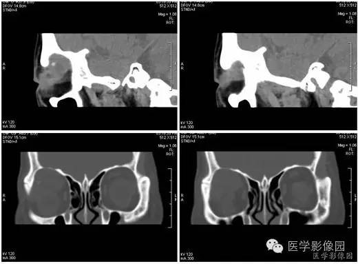 【病例】泪腺混合瘤1例CT影像表现 【病例】泪腺混合瘤1例CT影像表现