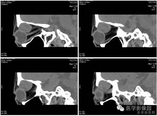 【病例】泪腺混合瘤1例CT影像表现 【病例】泪腺混合瘤1例CT影像表现