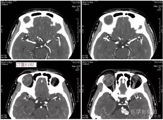 【病例】泪腺混合瘤1例CT影像表现 【病例】泪腺混合瘤1例CT影像表现