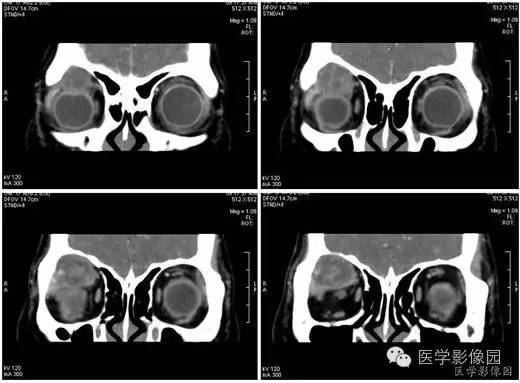 【病例】泪腺混合瘤1例CT影像表现 【病例】泪腺混合瘤1例CT影像表现