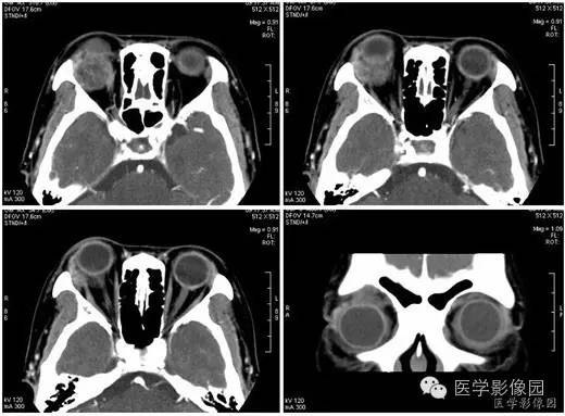 【病例】泪腺混合瘤1例CT影像表现 【病例】泪腺混合瘤1例CT影像表现
