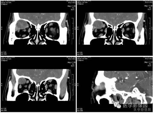 【病例】泪腺混合瘤1例CT影像表现 【病例】泪腺混合瘤1例CT影像表现