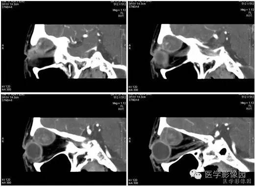 【病例】泪腺混合瘤1例CT影像表现 【病例】泪腺混合瘤1例CT影像表现