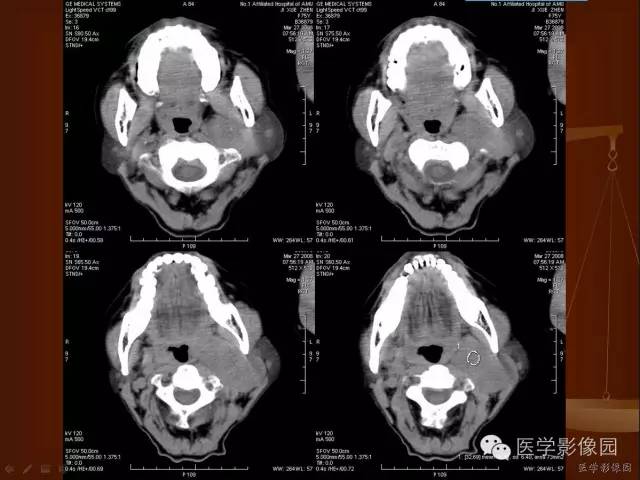 【病例】颈动脉体副神经节瘤1例CT影像表现