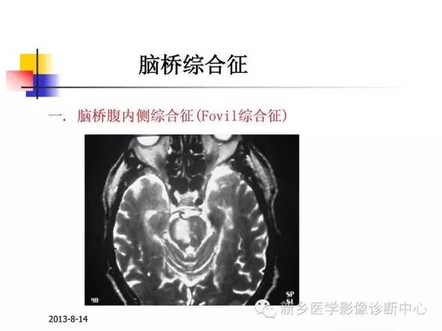 【PPT】影像综合征——脑桥的三大综合征