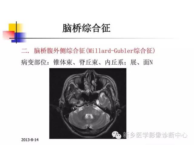 【PPT】影像综合征——脑桥的三大综合征