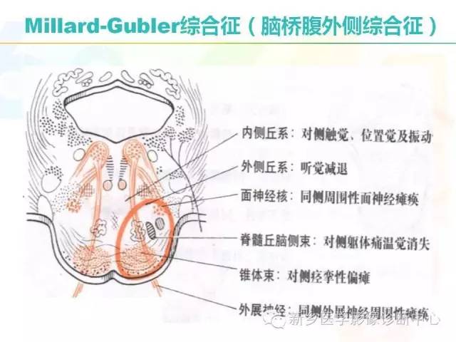 【PPT】影像综合征——脑桥的三大综合征