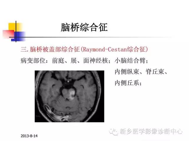 【PPT】影像综合征——脑桥的三大综合征
