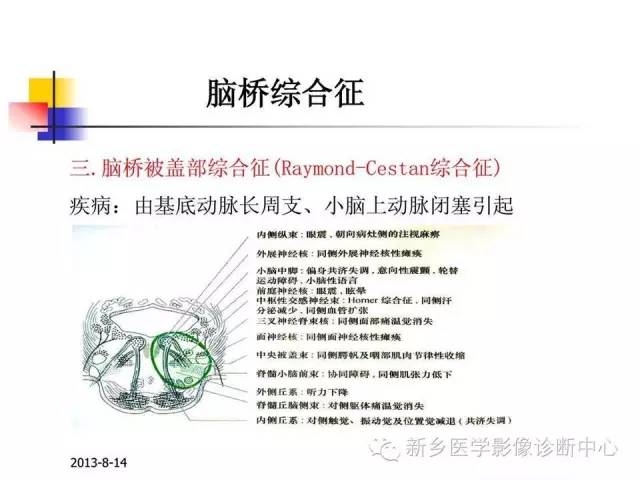 【PPT】影像综合征——脑桥的三大综合征