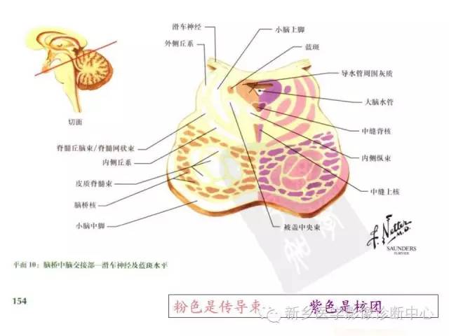 【PPT】影像综合征——脑桥的三大综合征