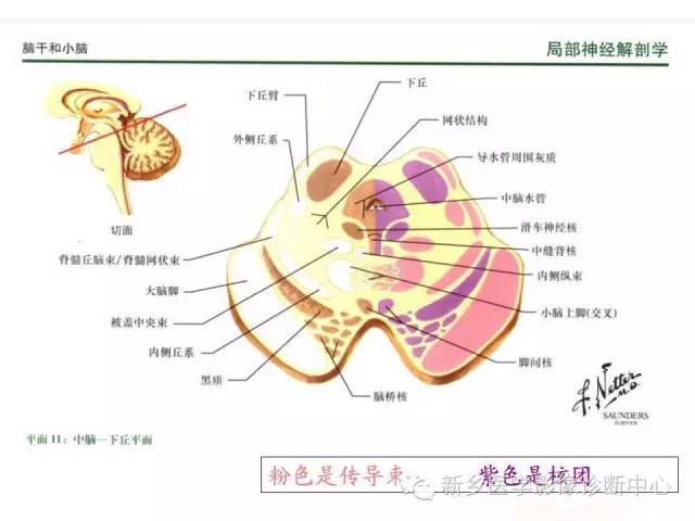 【PPT】影像综合征——脑桥的三大综合征