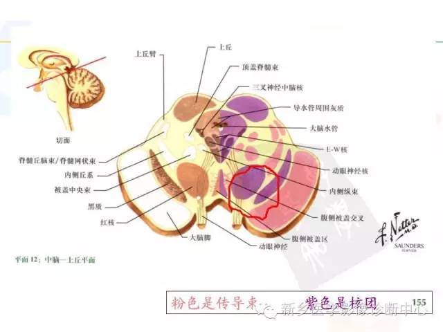 【PPT】影像综合征——脑桥的三大综合征