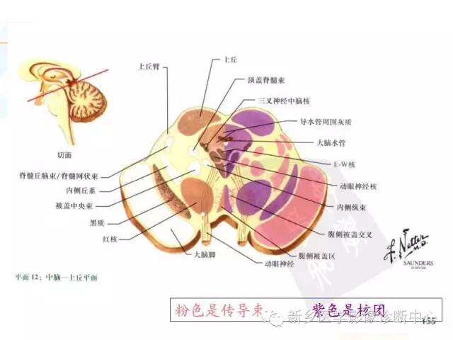 【PPT】影像综合征——脑桥的三大综合征