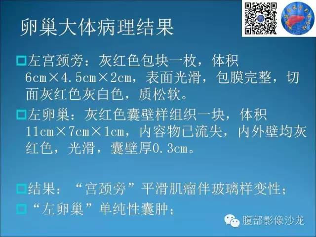 卵巢单纯性囊肿