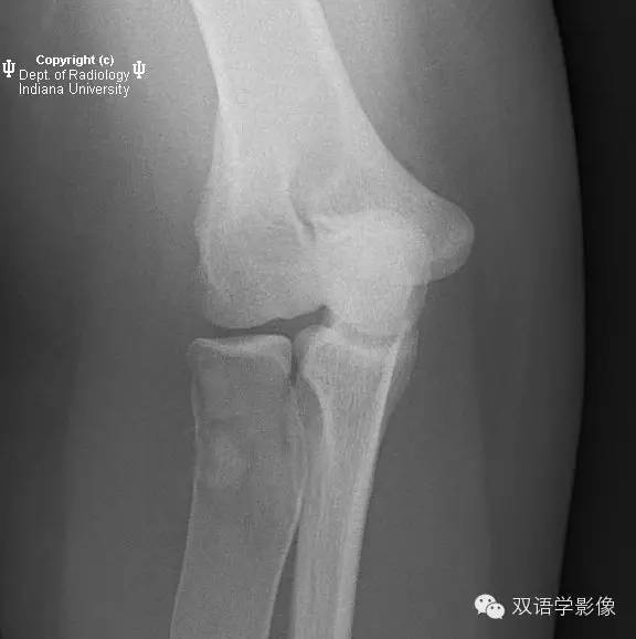 【双语病例】骨纤维结构不良继发动脉瘤样骨囊肿1例 【双语病例】骨纤维结构不良继发动脉瘤样骨囊肿1例
