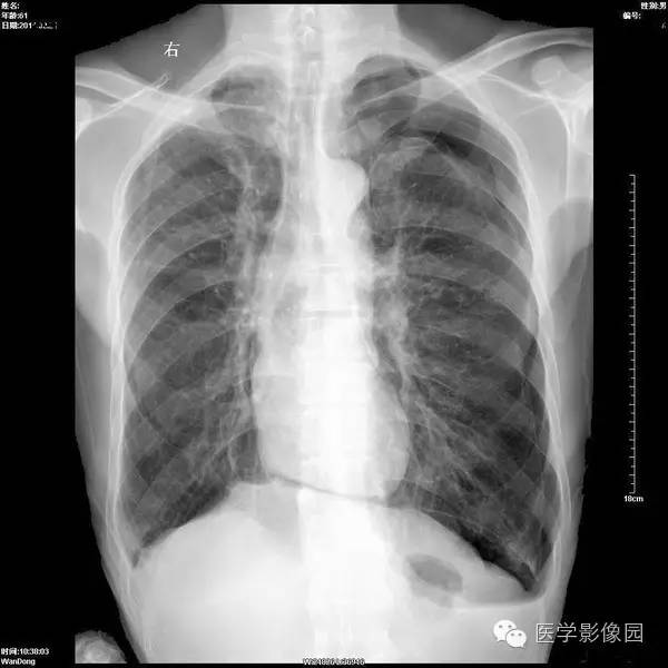 【影像征象】横膈连续征