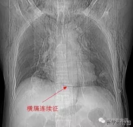 【影像征象】横膈连续征