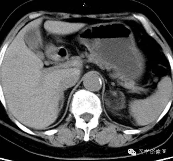 【病例】肾上腺髓样脂肪瘤1例CT影像表现 【病例】肾上腺髓样脂肪瘤1例CT影像表现