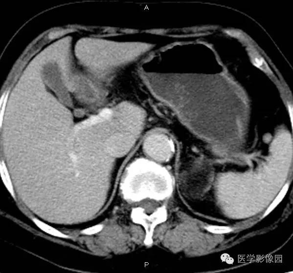 【病例】肾上腺髓样脂肪瘤1例CT影像表现 【病例】肾上腺髓样脂肪瘤1例CT影像表现