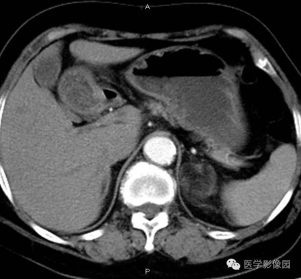 【病例】肾上腺髓样脂肪瘤1例CT影像表现 【病例】肾上腺髓样脂肪瘤1例CT影像表现