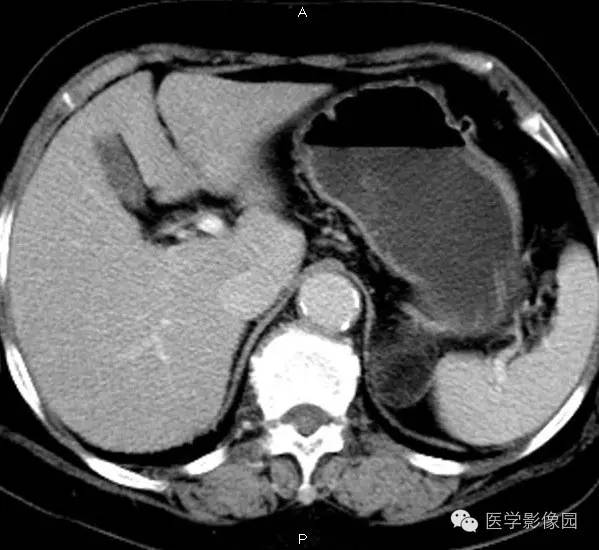 【病例】肾上腺髓样脂肪瘤1例CT影像表现 【病例】肾上腺髓样脂肪瘤1例CT影像表现
