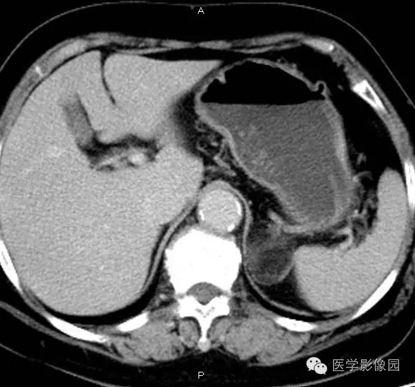 【病例】肾上腺髓样脂肪瘤1例CT影像表现 【病例】肾上腺髓样脂肪瘤1例CT影像表现