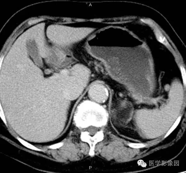 【病例】肾上腺髓样脂肪瘤1例CT影像表现 【病例】肾上腺髓样脂肪瘤1例CT影像表现