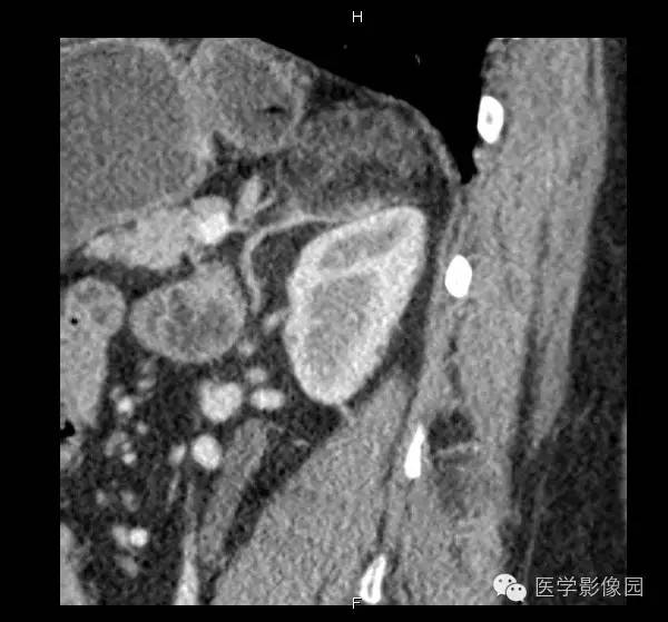 【病例】肾上腺髓样脂肪瘤1例CT影像表现 【病例】肾上腺髓样脂肪瘤1例CT影像表现