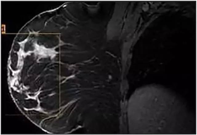 【病例】非典型乳腺硬化性腺病1例X线及MR影像表现 【病例】非典型乳腺硬化性腺病1例X线及MR影像表现