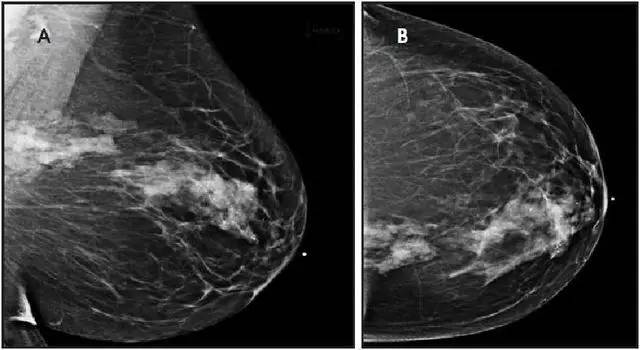 【病例】非典型乳腺硬化性腺病1例X线及MR影像表现