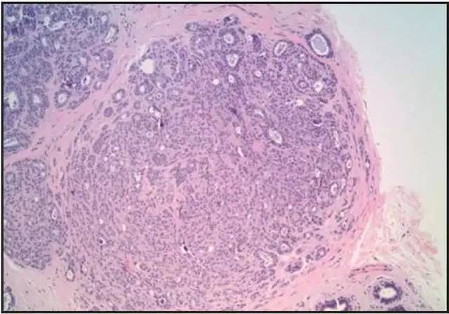 【病例】非典型乳腺硬化性腺病1例X线及MR影像表现 【病例】非典型乳腺硬化性腺病1例X线及MR影像表现