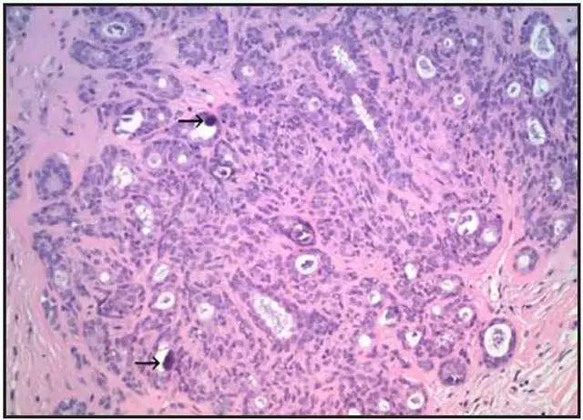 【病例】非典型乳腺硬化性腺病1例X线及MR影像表现 【病例】非典型乳腺硬化性腺病1例X线及MR影像表现