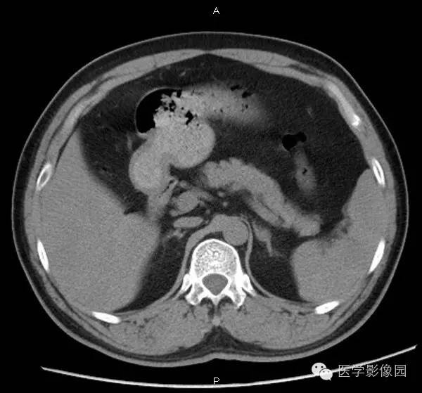 【病例】肾上腺血管瘤1例CT影像表现