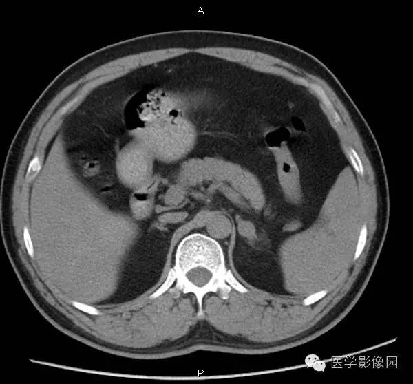 【病例】肾上腺血管瘤1例CT影像表现 【病例】肾上腺血管瘤1例CT影像表现