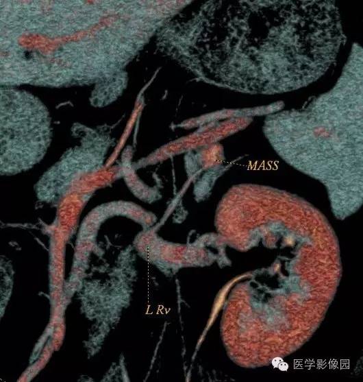 【病例】肾上腺血管瘤1例CT影像表现 【病例】肾上腺血管瘤1例CT影像表现
