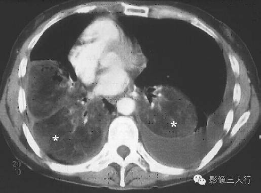 外源性类脂性肺炎