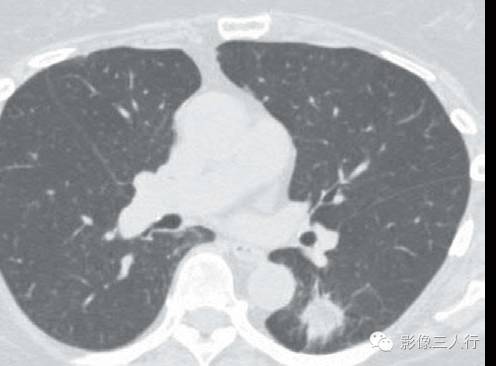 外源性类脂性肺炎
