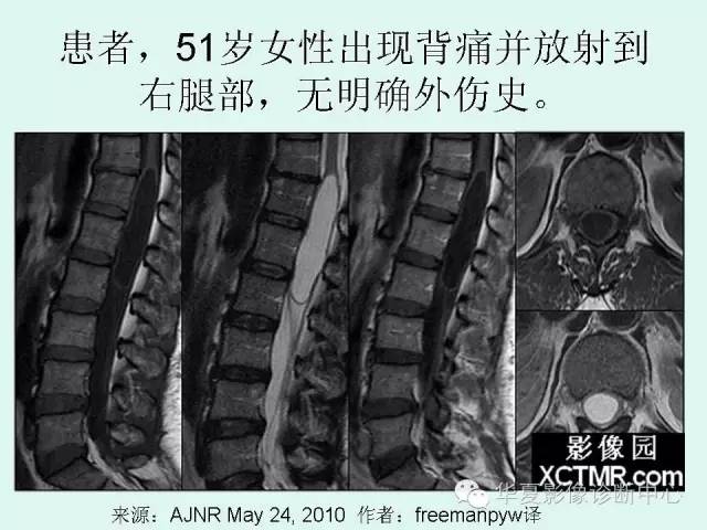 【病例】终室（第五脑室）1例MR影像表现
