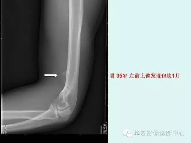 【病例】肱骨髁上突1例X线影像表现