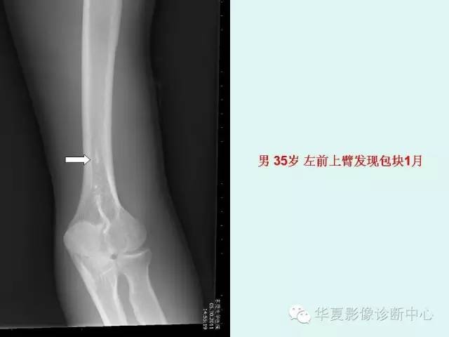 【病例】肱骨髁上突1例X线影像表现