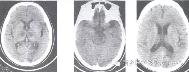基底动脉尖综合征 基底动脉尖综合征