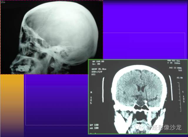 【病例】颅内鞍区病变七例鉴别诊断分析 【病例】颅内鞍区病变七例鉴别诊断分析